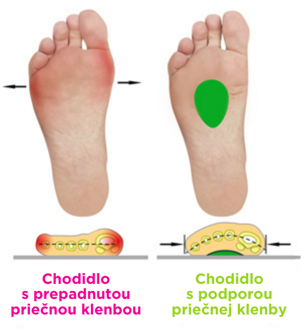 Chodidlo s prepadnutou priecnou klenbou